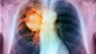 tumore-al-polmone